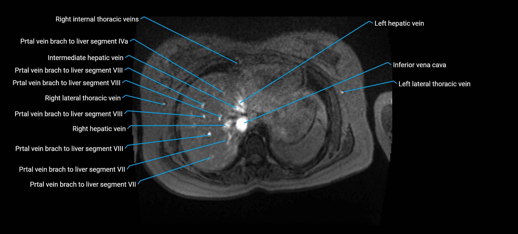 MRV abdomen pelvis & lower limb axial cross sectional anatomy labelled MRI image 21 (1).webp